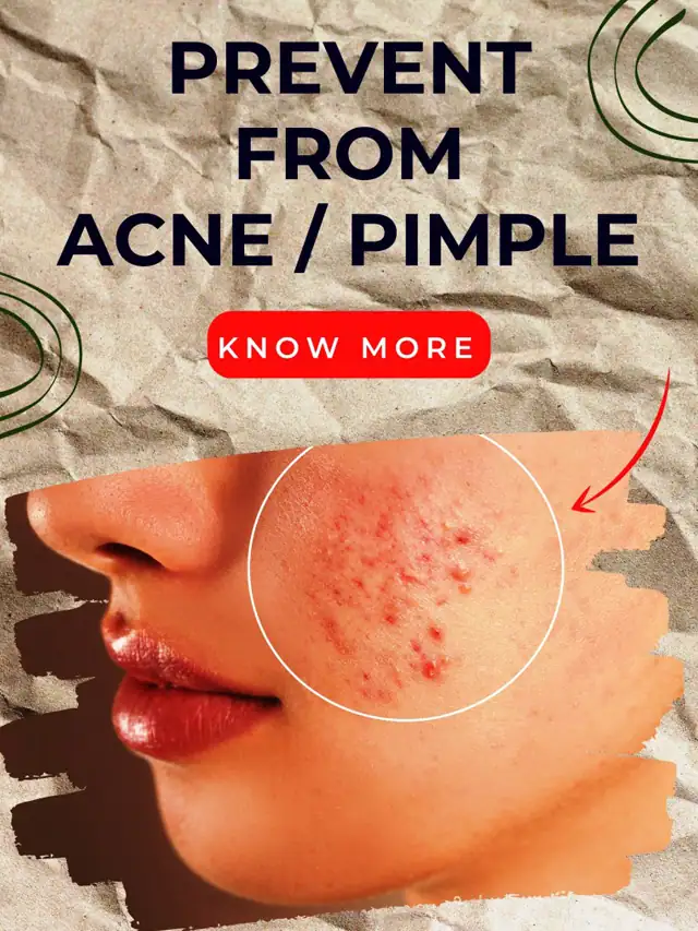 Top 10 pimple or acne treatment at Home